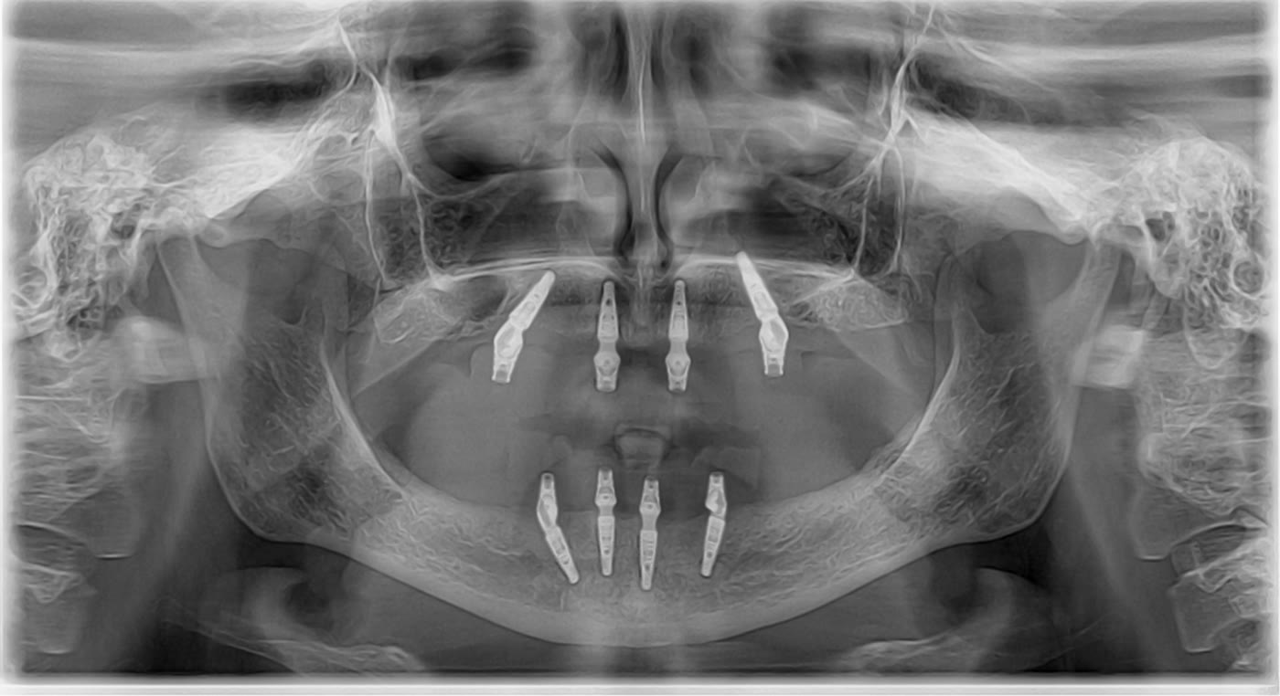 Radiografie panoramică anonimizată cu implanturile