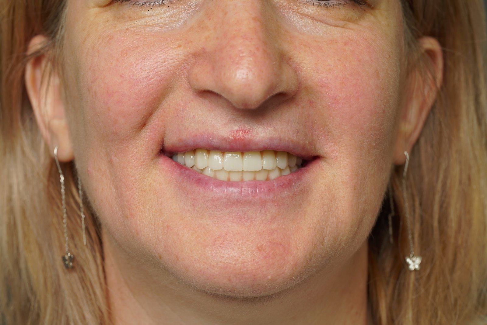 Zâmbetul după tratament, în detaliu