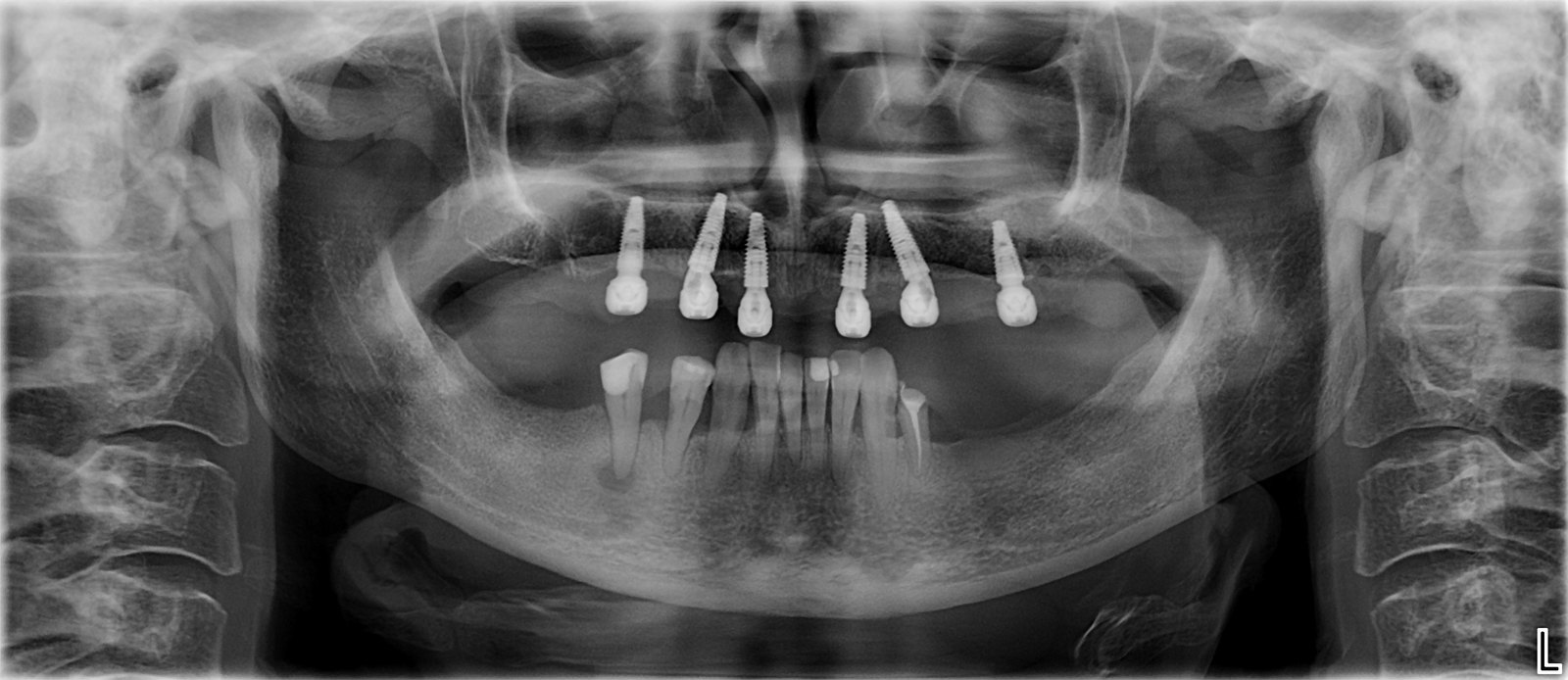 Radiografie panoramică anonimizată cu implanturile
