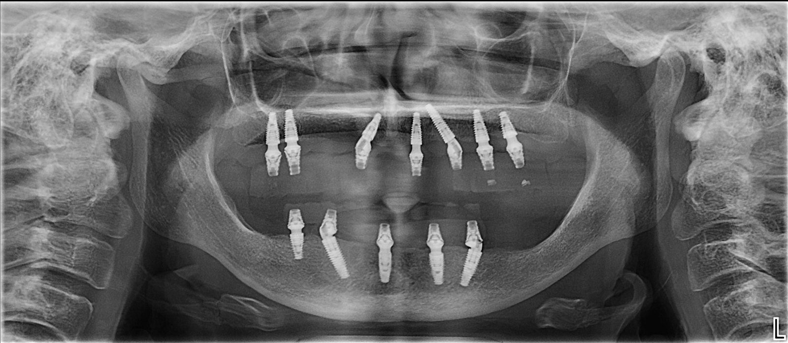 Radiografie panoramică anonimizată cu implanturile