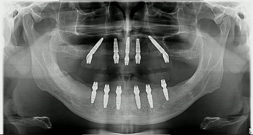 Radiografie panoramică anonimizată cu implanturile