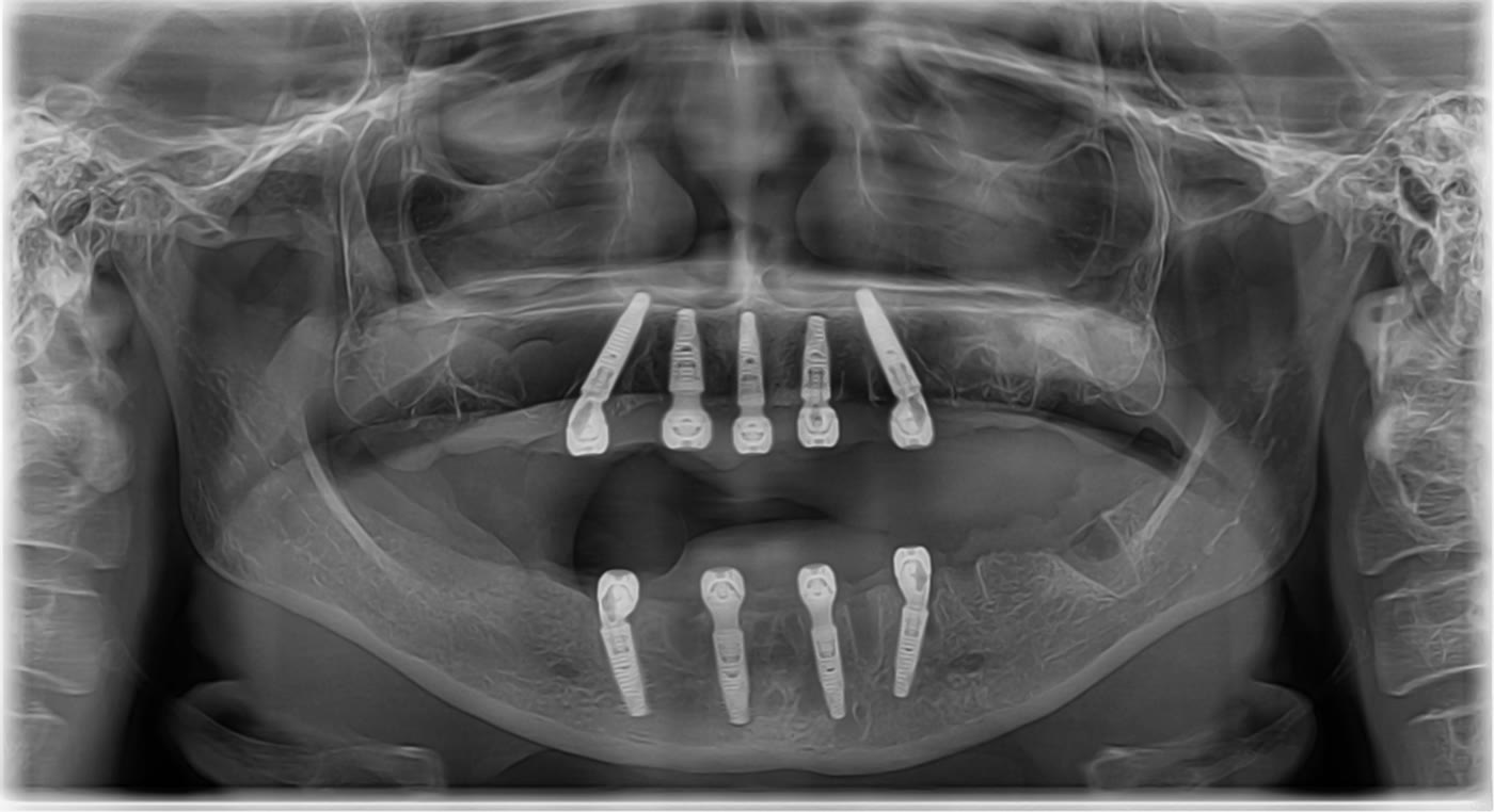 Radiografie panoramică anonimizată cu implanturile