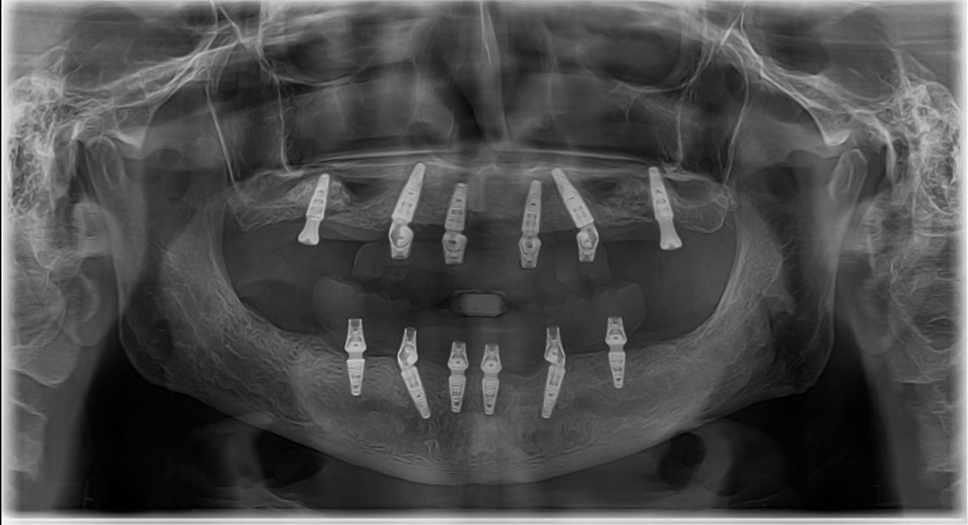 Radiografie panoramică anonimizată cu implanturile