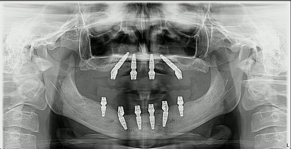 Radiografie panoramică anonimizată, cu implanturile care susțin lucrarea fixă pe ambele arcade